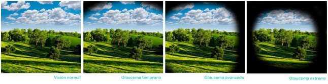 El glaucoma, ladrón silencioso de la visión 1 glaucoma